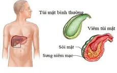 Những biến chứng nguy hiểm của sỏi mật