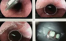 Người đàn ông phải đi viện vì uống thuốc còn nguyên vỏ