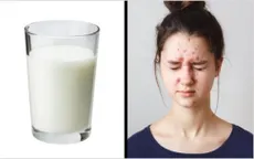 Hãy hạn chế những thực phẩm gây lão hóa da, nếp nhăn và mụn trứng cá