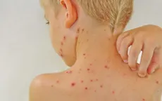 Bỏ túi cách ngừa bệnh dị ứng gây phiền toái mùa đông