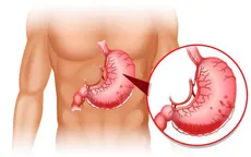 Những thực phẩm mà người đau dạ dày cần tránh xa