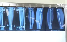 Thành công mới trong triển khai phẫu thuật kéo dài chân