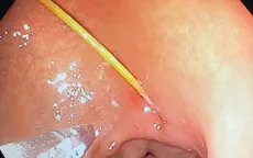 Chiếc tăm nhọn găm vào dạ dày tạo thành ổ loét