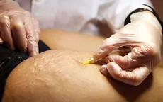 Nguyên nhân gây rạn da và cách khắc phục