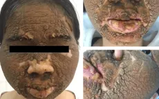 Tổn thương da nghiêm trọng do dùng thuốc trắng da không rõ nguồn gốc