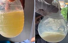 Dịch rò hàng lít từ cổ bệnh nhân ung thư tuyến giáp
