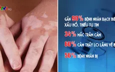 Giúp người bị bạch biến đỡ mặc cảm