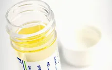 Xét nghiệm nước tiểu có thể giúp phát hiện ung thư tuyến tiền liệt sớm