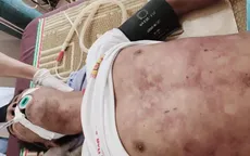 Một người tử vong ở Sơn La do nhiễm khuẩn cầu lợn