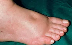 Những nguyên nhân khiến bàn chân bị sưng tấy