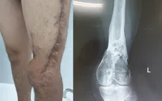 Lần đầu ghép gân cơ tứ đầu đùi hồi phục chân trái bị thương do tai nạn giao thông