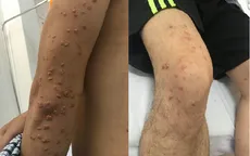 Người đàn ông trẻ vào viện với làn da nổi đầy u cục