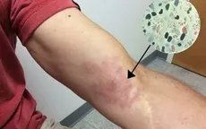 Phát hiện mắc bệnh "phong cùi " từ vết bầm tím trên da