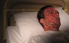 Nguy cơ dịch sốt phát ban đen bùng phát ở Bolivia