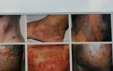 Những mối nguy từ việc cố tẩy trắng da