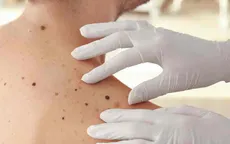 Tỷ lệ ung thư da ở Anh tăng 45%