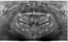 Cảnh giác rối loạn mọc răng vĩnh viễn ở trẻ em