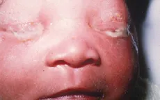 Viêm kết mạc ở trẻ sơ sinh do vi khuẩn chlamydia trachomatis