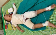Bé trai hơn 3 tuổi người Mông bị bỏng nước sôi nguy kịch cần giúp đỡ