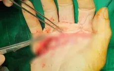 Cứu người thợ nhôm kính bị máy cắt gần đứt lìa các ngón tay