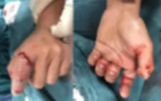 Nối ngón tay bị đứt lìa do cưa máy cắt cho thanh niên 18 tuổi