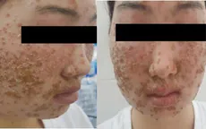 Khuôn mặt phủ kín vảy sau khi dùng sữa rửa mặt mua qua mạng
