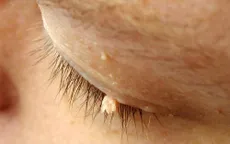Chỉ quan hệ tình dục mới mắc sùi mào gà?