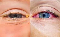 Nguyên nhân khiến mắt bị dị ứng