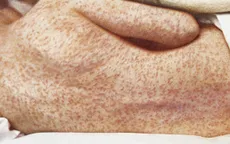 Dịch sởi bùng phát ở Mỹ với hàng trăm ca nhiễm mới