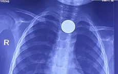 Bé trai 3 tuổi phải vào viện vì đồng xu mắc kẹt ở thực quản