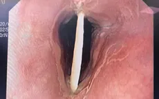 Đi ăn cỗ về, cụ bà 72 tuổi phải vào viện vì hóc xương