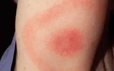 Những dấu hiệu nguy hiểm khi bị côn trùng cắn