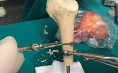 Hy vọng mới cho bệnh nhân ung thư xương