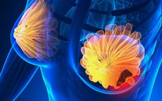Liệu pháp chỉnh sửa gen giúp ngăn ung thư vú phát triển