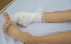 Cứu bé gái 14 tuổi mang căn bệnh hiếm gặp ở bàn chân