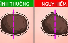 5 tín hiệu từ nốt ruồi cảnh báo ung thư đang tiềm ẩn