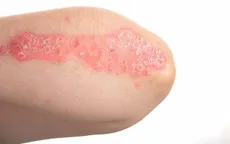 Bệnh vảy nến có lây?