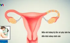 Tắc vòi trứng - Thủ phạm gây vô sinh ở phụ nữ