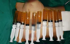 Ngực to như quả bóng, chực "phát nổ" sau khi đặt túi ngực