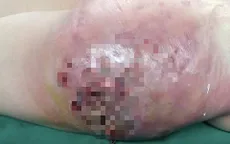 Hiểm họa mang tên silicon lỏng