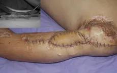 Tái tạo khuyết xương cánh tay bằng vạt xương mác tự do