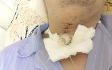 Tổn thương khí quản do đá mài bắn vào