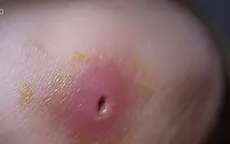 Coi chừng nhiễm trùng máu vì mụn nhọt