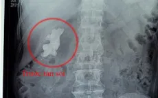Tán nhỏ "củ gừng" trong thận người đàn ông