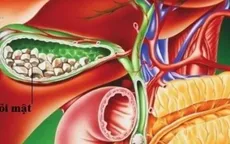 60% người tuổi trung niên bị sỏi mật