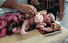 Bé gái sơ sinh có… 4 chân 4 tay ở Ấn Độ