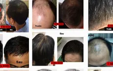 Có chăng công dụng thần kỳ của thuốc chữa hói đầu, rụng tóc?