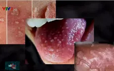 Bệnh sùi mào gà có thể dẫn đến ung thư nếu không điều trị đúng và kịp thời