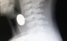 Lấy bánh xe đồ chơi trong thực quản bé trai 4 tuổi