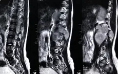 Hồi sinh đôi chân bị liệt cho bé gái 5 tuổi từng bị nhiều bệnh viện từ chối phẫu thuật